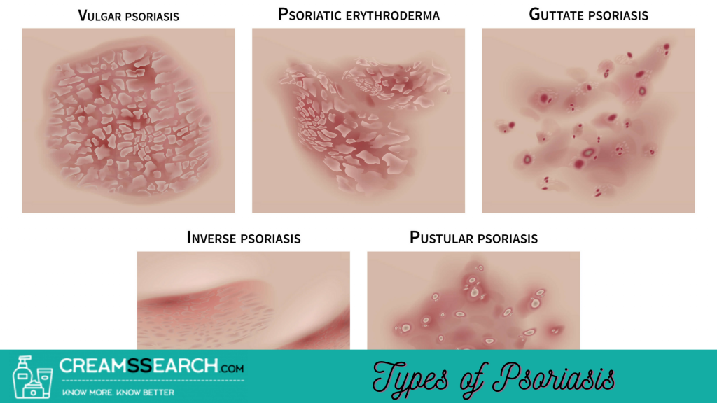 What is Psoriasis, Causes & Types? Find the Best Psoriasis ...